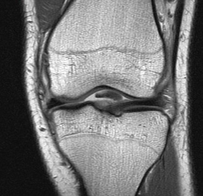 Figure 2 for case Unstable displaced lateral meniscus flap tear( RID2763 )